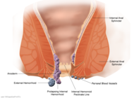 External hemorrhoids - anatomical structure
